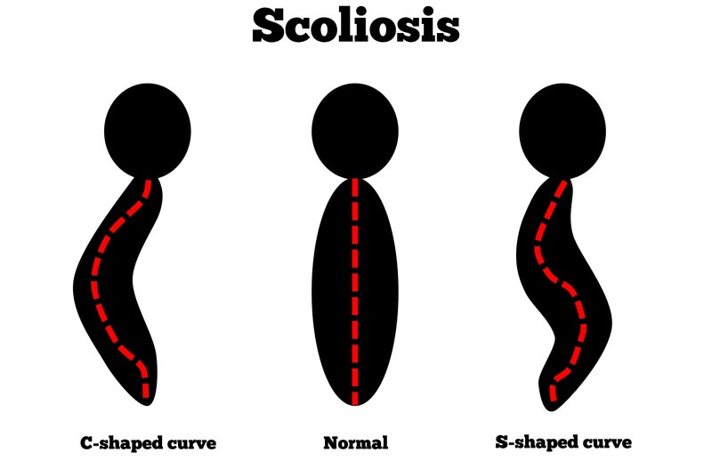 Tacoma, wa scoliosis treatment